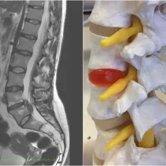 Obok obrazu MRI kręgosłupa lędźwiowego, model anatomiczny pokazuje wypuklinę krążka międzykręgowego, która uciska nerwy. To jest ten worek oponowy w kręgosłupie.