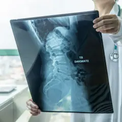 Lekarz analizuje RTG kręgosłupa, oceniając stan pacjenta przed operacją skoliozy u dorosłych.