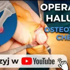 Operacja haluksów na NFZ: Jak skrócić kolejkę? Pełny przewodnik