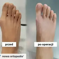 Haluksy: Gdzie najlepiej operować? Porównaj kliniki i metody.