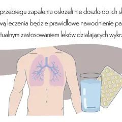 Leczenie zapalenia oskrzeli: Kiedy antybiotyk, a kiedy domowe sposoby?