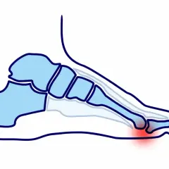 Anatomia stopy z zaznaczonym czerwonym obszarem bólu poduszki stopy.