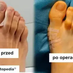 Cena operacji haluksów: NFZ czy prywatnie? Uniknij ukrytych kosztów!