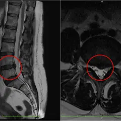 Obraz MRI kręgosłupa lędźwiowego pokazuje sekwestrację krążka międzykręgowego, fragment dysku uciskający nerwy.