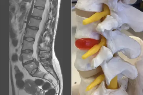 Obok obrazu MRI kręgosłupa lędźwiowego, model anatomiczny pokazuje wypuklinę krążka międzykręgowego, która uciska nerwy. To jest ten worek oponowy w kręgosłupie.