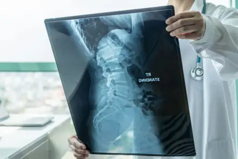 Lekarz analizuje RTG kręgosłupa, oceniając stan pacjenta przed operacją skoliozy u dorosłych.