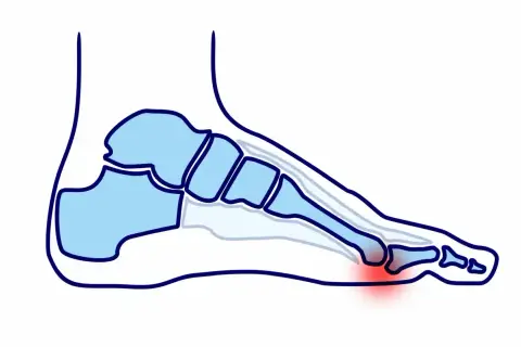 Anatomia stopy z zaznaczonym czerwonym obszarem bólu poduszki stopy.