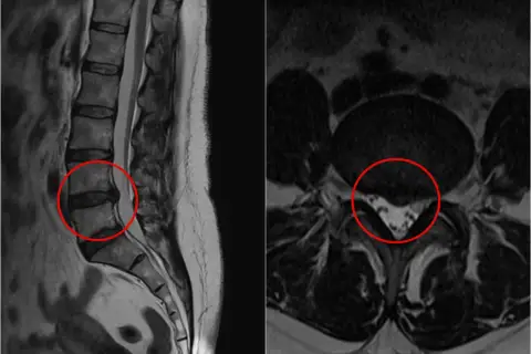 Obraz MRI kręgosłupa lędźwiowego pokazuje sekwestrację krążka międzykręgowego, fragment dysku uciskający nerwy.