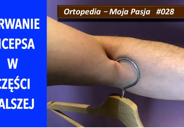 Zerwanie bicepsa w części dalszej. Metalowy haczyk wisi na zgięciu łokcia, symbolizując uraz.