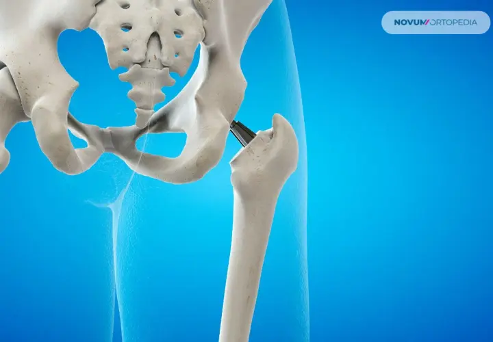 Endoproteza stawu biodrowego: implant zastępujący uszkodzoną kość. Widok anatomiczny.