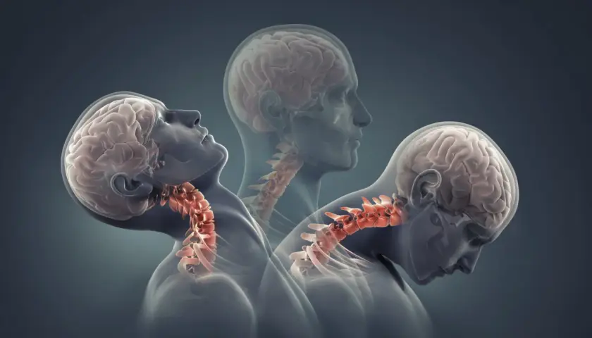 Trzy sylwetki ukazujące ruch głowy i szyi, ilustrujące mechanizm urazu whiplash.