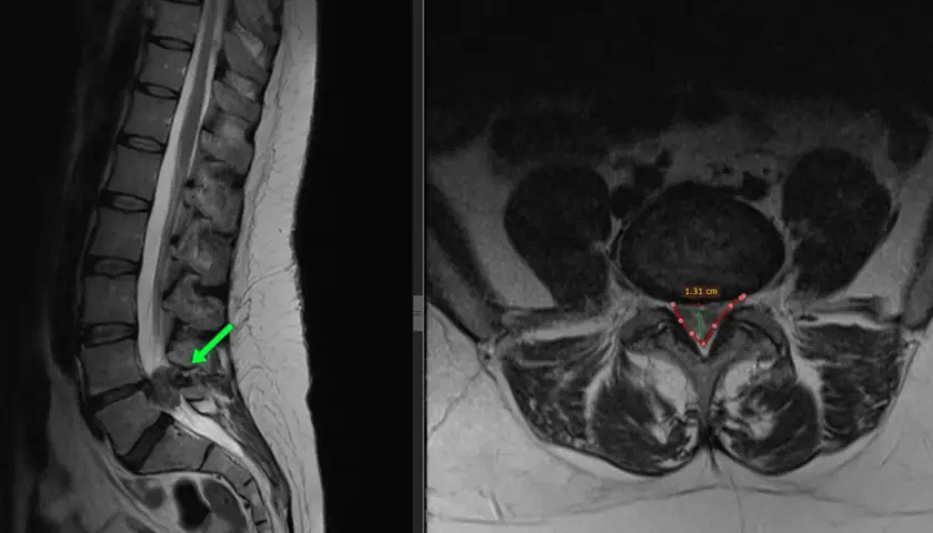 MRI kręgosłupa lędźwiowego z widoczną przepukliną krążka międzykręgowego, zaznaczoną zieloną strzałką. Widoczny pomiar 1.31 cm.
