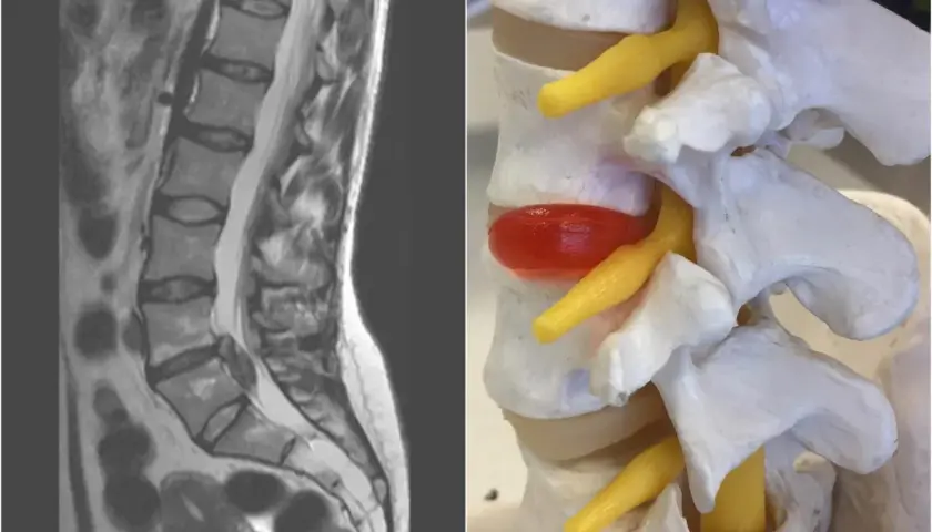 Obok obrazu MRI kręgosłupa lędźwiowego, model anatomiczny pokazuje wypuklinę krążka międzykręgowego, która uciska nerwy. To jest ten worek oponowy w kręgosłupie.