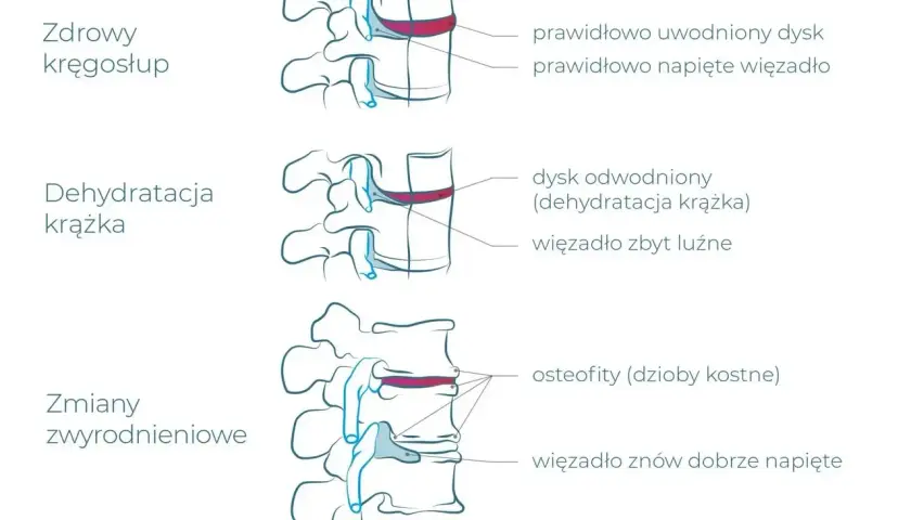 Ilustracja pokazuje postęp zwyrodnienia kręgosłupa lędźwiowego: od zdrowego dysku, przez jego odwodnienie, po zmiany zwyrodnieniowe z osteofitami.