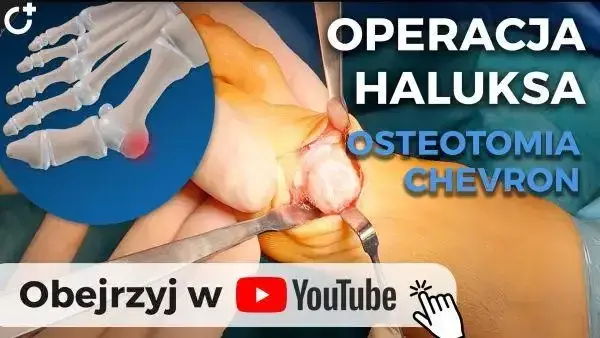 Operacja haluksów na NFZ: Jak skrócić kolejkę? Pełny przewodnik