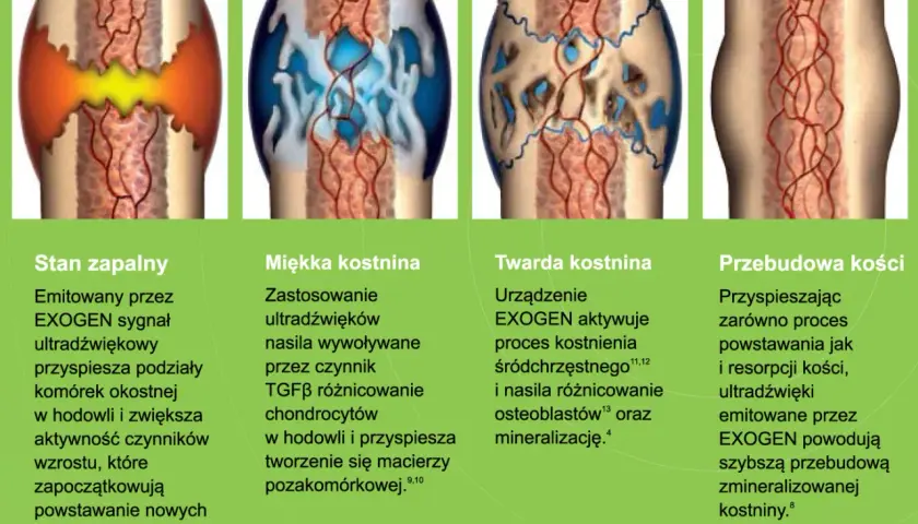 Ilustracja pokazuje etapy gojenia kości piszczelowej: stan zapalny, miękką i twardą kostninę oraz przebudowę kości.