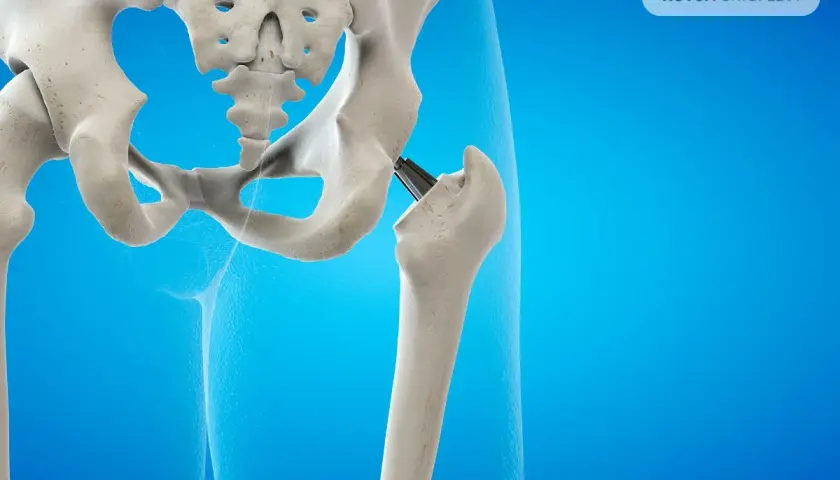 Endoproteza stawu biodrowego: implant zastępujący uszkodzoną kość. Widok anatomiczny.