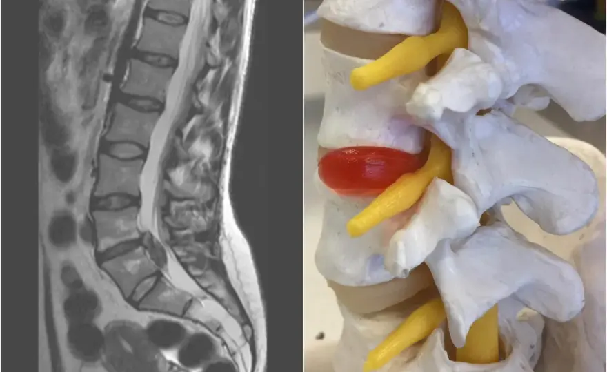 Worek oponowy w kręgosłupie - kiedy ucisk w MRI ma znaczenie?