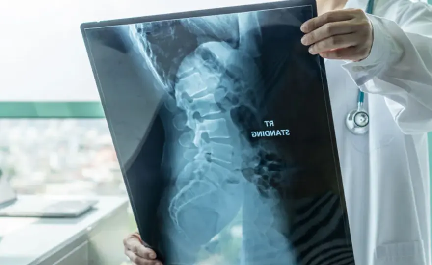 Operacja skoliozy u dorosłych - kiedy ma sens i czego się spodziewać?