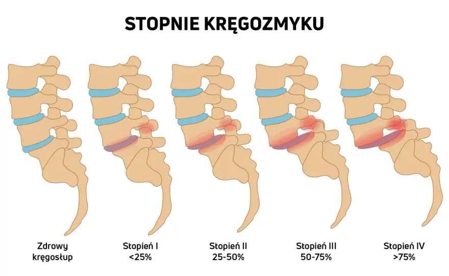 Kręgozmyk - objawy, których nie warto ignorować