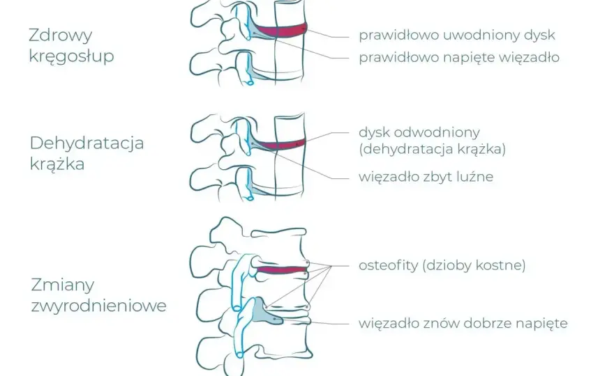 Zwyrodnienie kręgosłupa lędźwiowego - kiedy badać i jak leczyć?