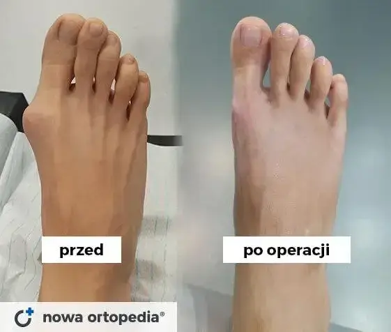 Haluksy: Gdzie najlepiej operować? Porównaj kliniki i metody.