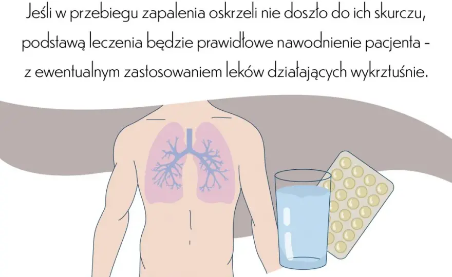 Leczenie zapalenia oskrzeli: Kiedy antybiotyk, a kiedy domowe sposoby?