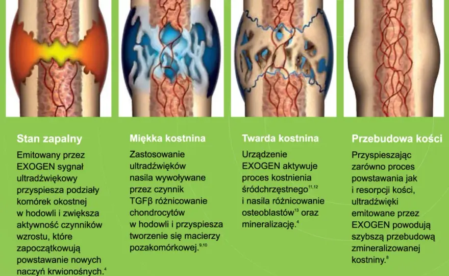 Jak długo zrasta się kość piszczelowa? Co wpływa na zrost