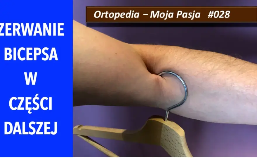 Przyczep bicepsa - jak rozpoznać ból i zerwanie?