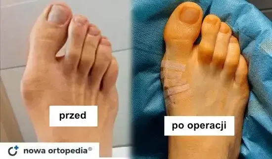 Cena operacji haluksów: NFZ czy prywatnie? Uniknij ukrytych kosztów!