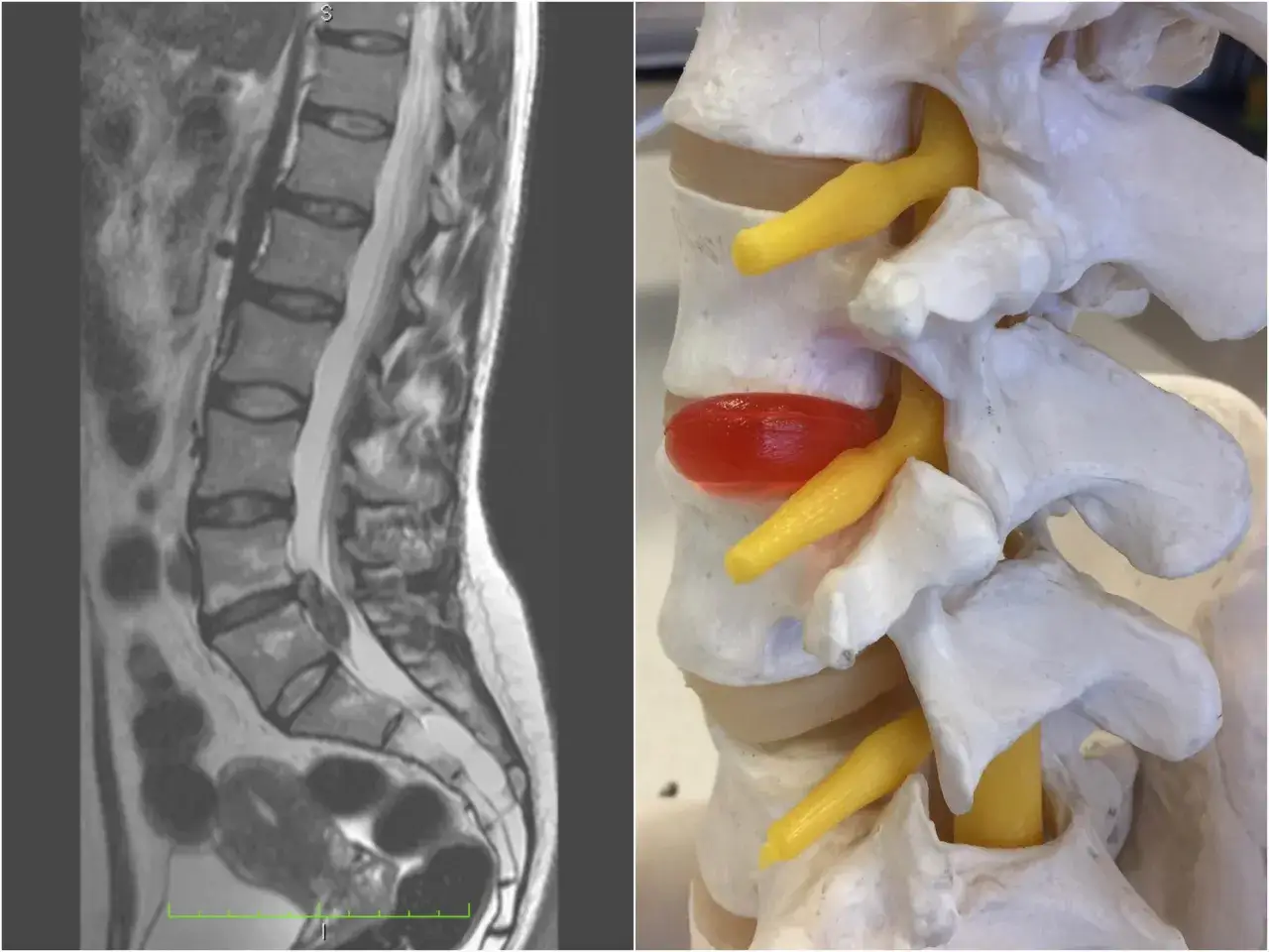 MRI kręgosłupa lędźwiowego i model anatomiczny ukazujący sekwestrację krążka międzykręgowego uciskającą nerw.