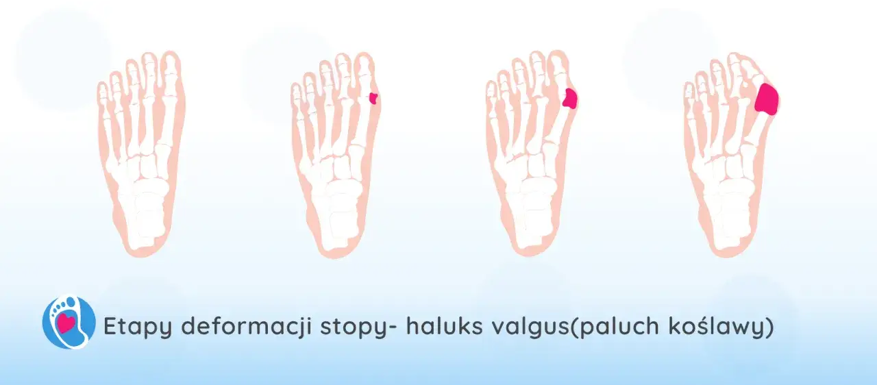 haluksy stopa deformacja etapy