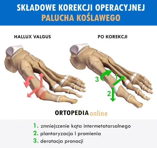 Różne metody operacji haluksów schematy