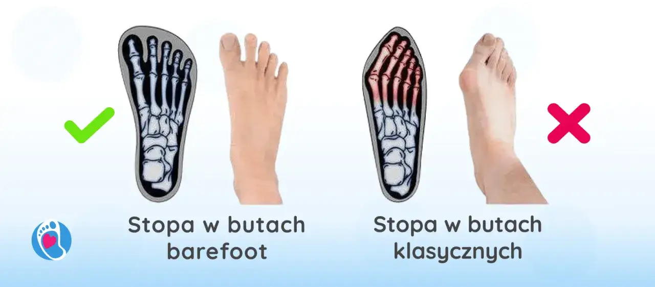 Buty na haluksy i ich wpływ na stopę