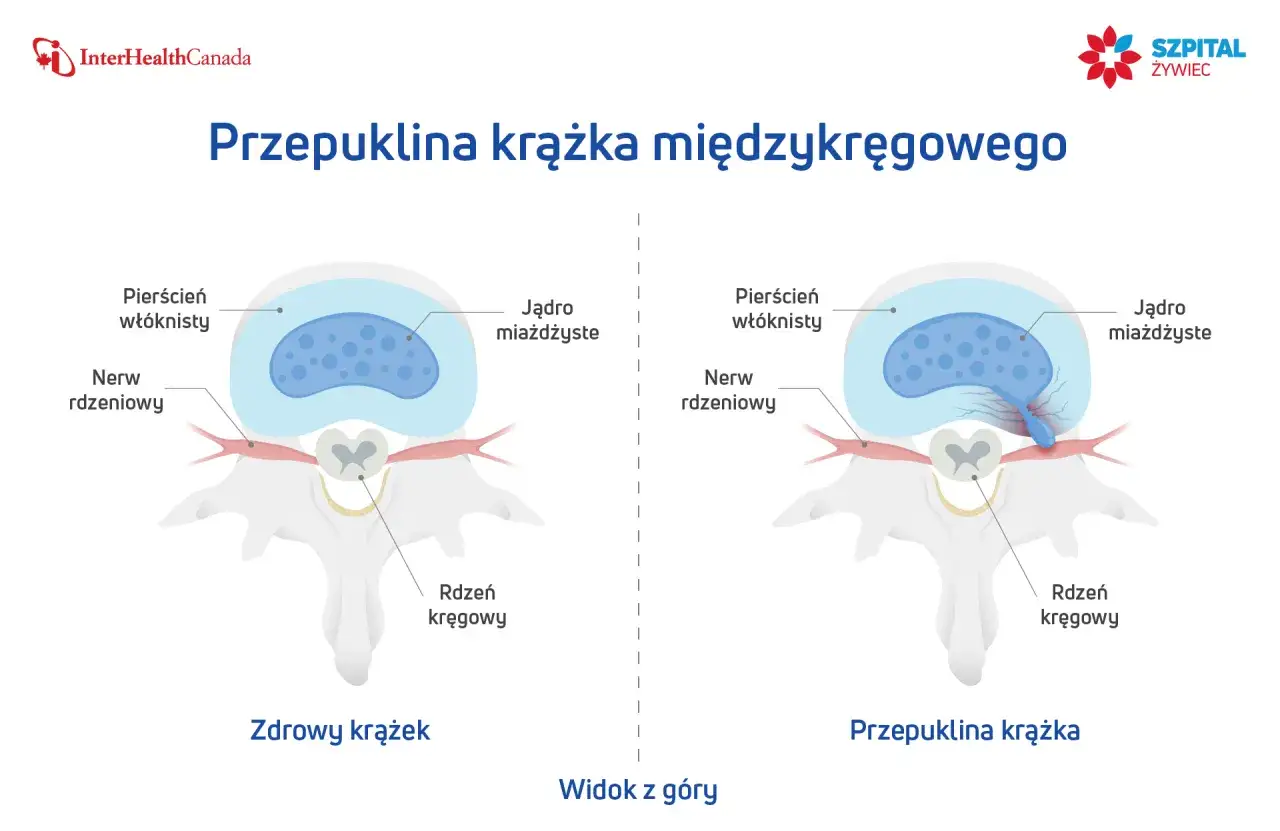 Porównanie zdrowego krążka międzykręgowego i krążka z przepukliną uciskającą nerw rdzeniowy.