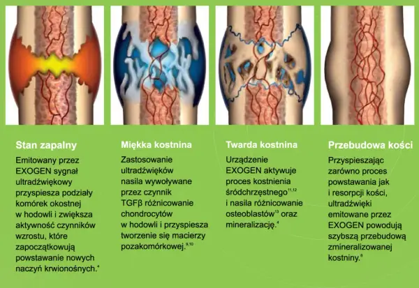 Ilustracja pokazuje etapy gojenia kości piszczelowej: stan zapalny, miękką i twardą kostninę oraz przebudowę kości.