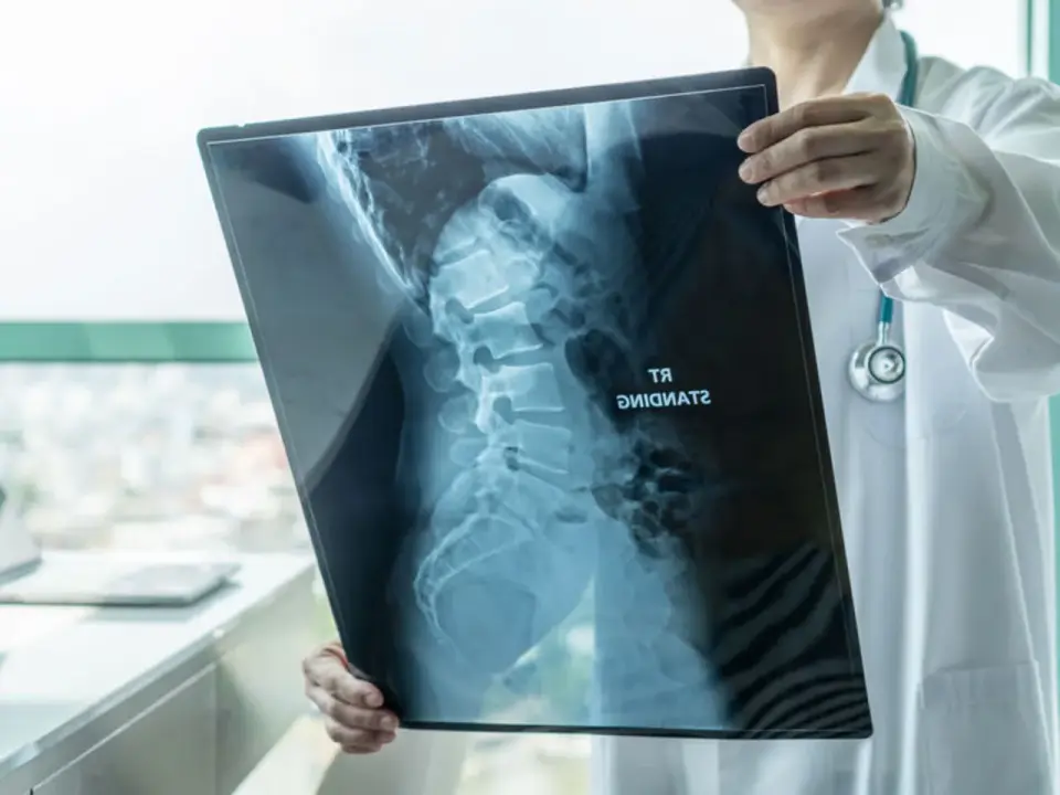 Operacja skoliozy u dorosłych - kiedy ma sens i czego się spodziewać?
